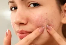 What Are the Simple Remedies for Reducing Facial Redness? How to Apply Derma Cream